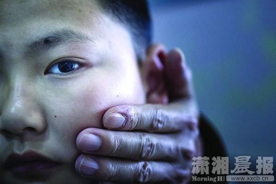 1月13日，小玨的父親心疼地摸著兒子的臉。